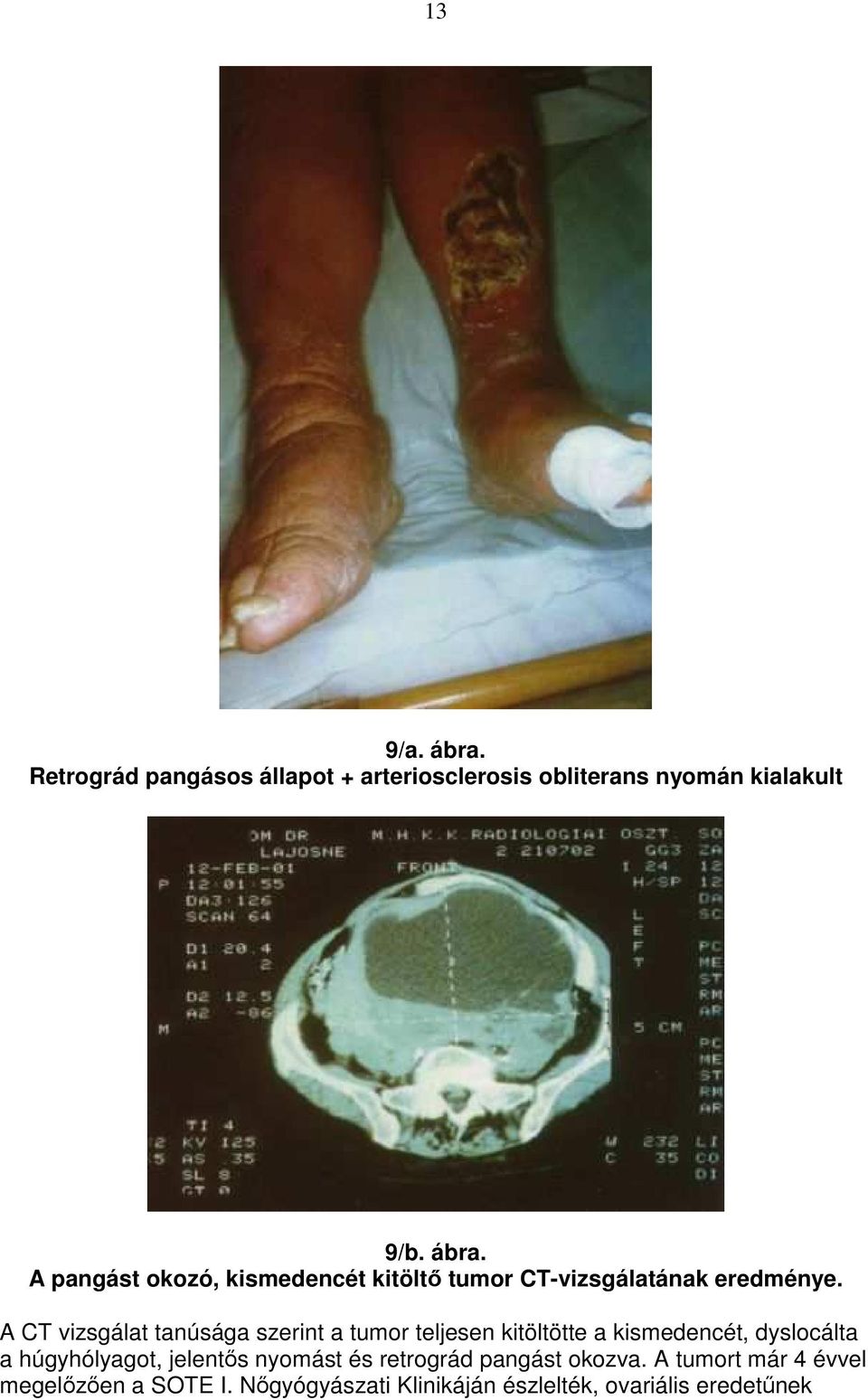 jelentıs nyomást és retrográd pangást okozva. A tumort már 4 évvel megelızıen a SOTE I.