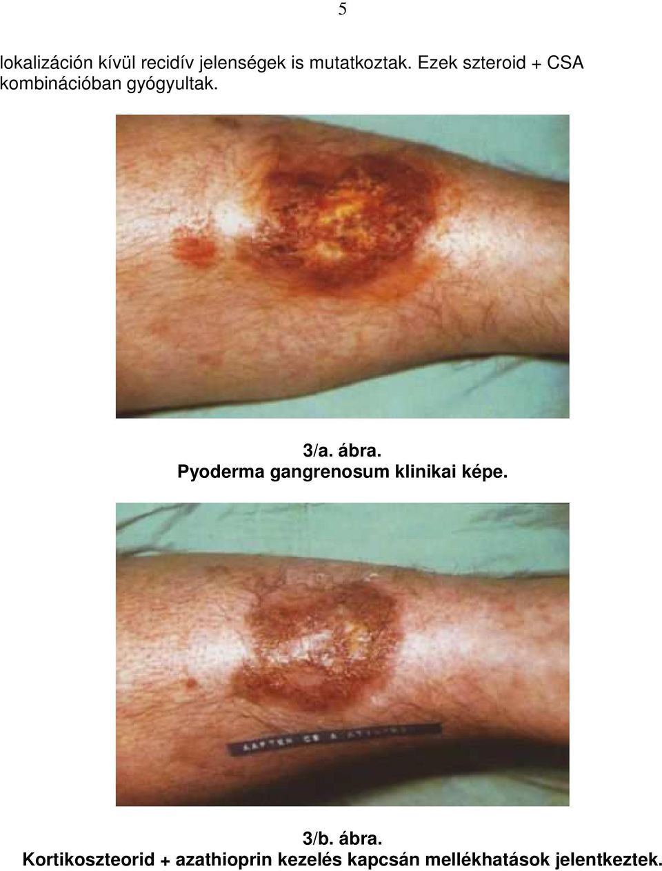 Pyoderma gangrenosum klinikai képe. 3/b. ábra.