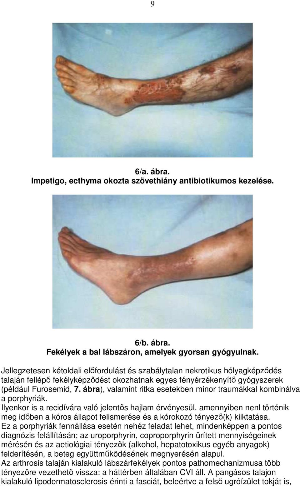 ábra), valamint ritka esetekben minor traumákkal kombinálva a porphyriák. Ilyenkor is a recidívára való jelentıs hajlam érvényesül.