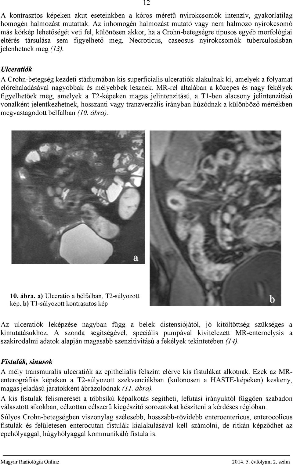 Necroticus, cseosus nyirokcsomók tuerculosisn jelenhetnek meg (13). A Crohn-etegség kezdeti stádiumán kis superficilis ulcertiók lkulnk ki, melyek folymt előrehldásávl ngyok és mélyeek lesznek.