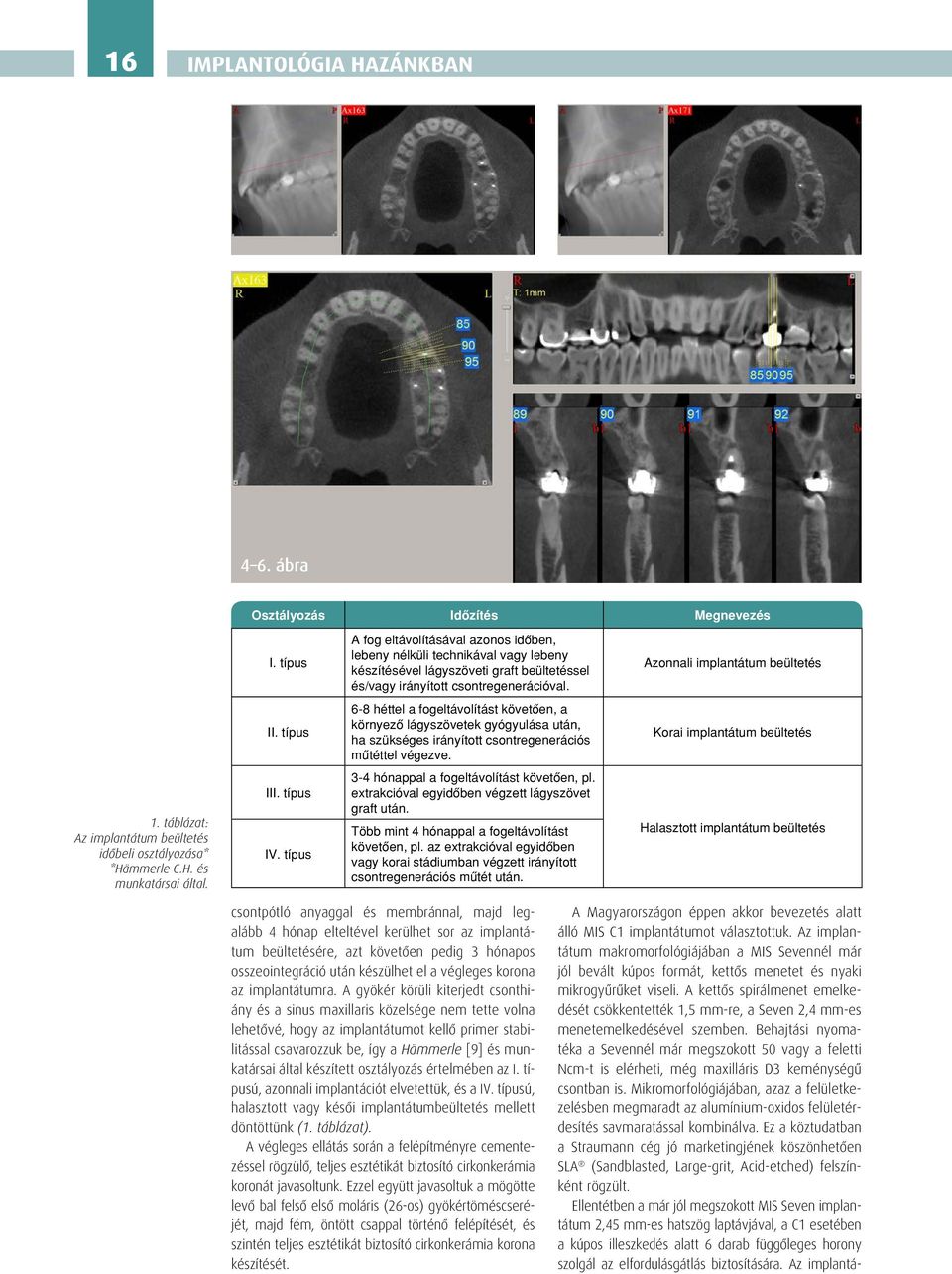típus 6-8 héttel a fogeltávolítást követôen, a környezô lágyszövetek gyógyulása után, ha szükséges irányított csontregenerációs mûtéttel végezve. Korai implantátum beültetés 1.
