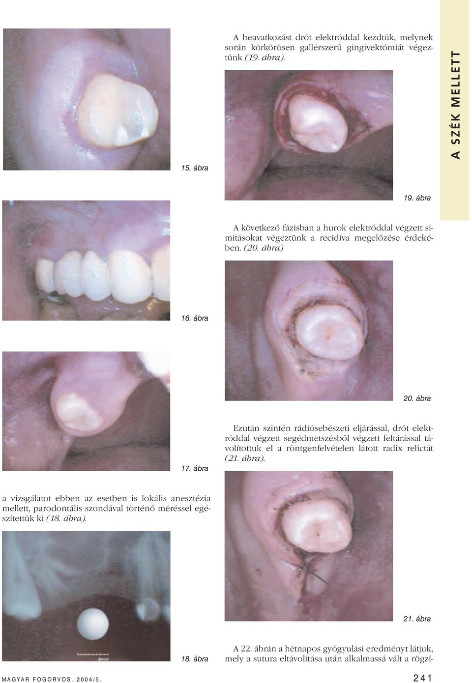 ábra Ezután szintén rádiósebészeti eljárással, drót elektróddal végzett segédmetszésből végzett feltárással távolítottuk el a röntgenfelvételen látott radix relictát (21. ábra).