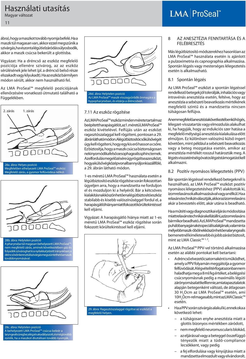 Ha az eszköz bármilyen módon sérült, akkor nem használható fel. Az LMA ProSeal megfelelő pozíciójának ellenőrzésére vonatkozó útmutató található a Függelékben. 2. zárás 1. zárás 28a.