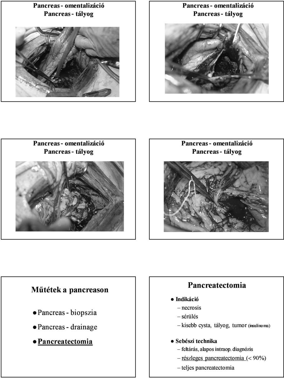 Pancreatectomia necrosis sérülés Pancreatectomia kisebb cysta, tályog, tumor tumor