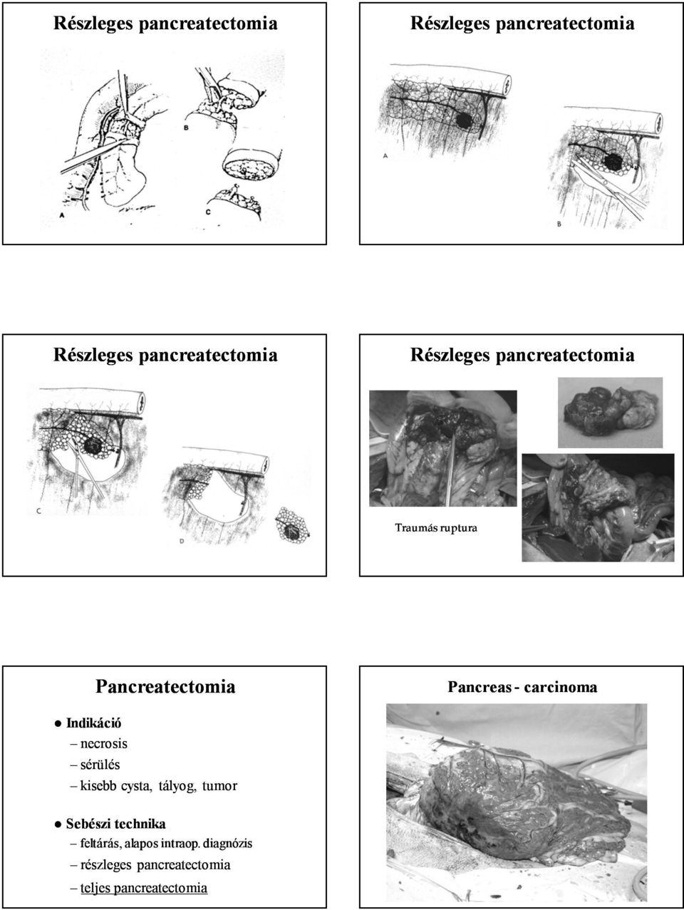 Pancreatectomia Pancreas - carcinoma necrosis sérülés kisebb cysta,