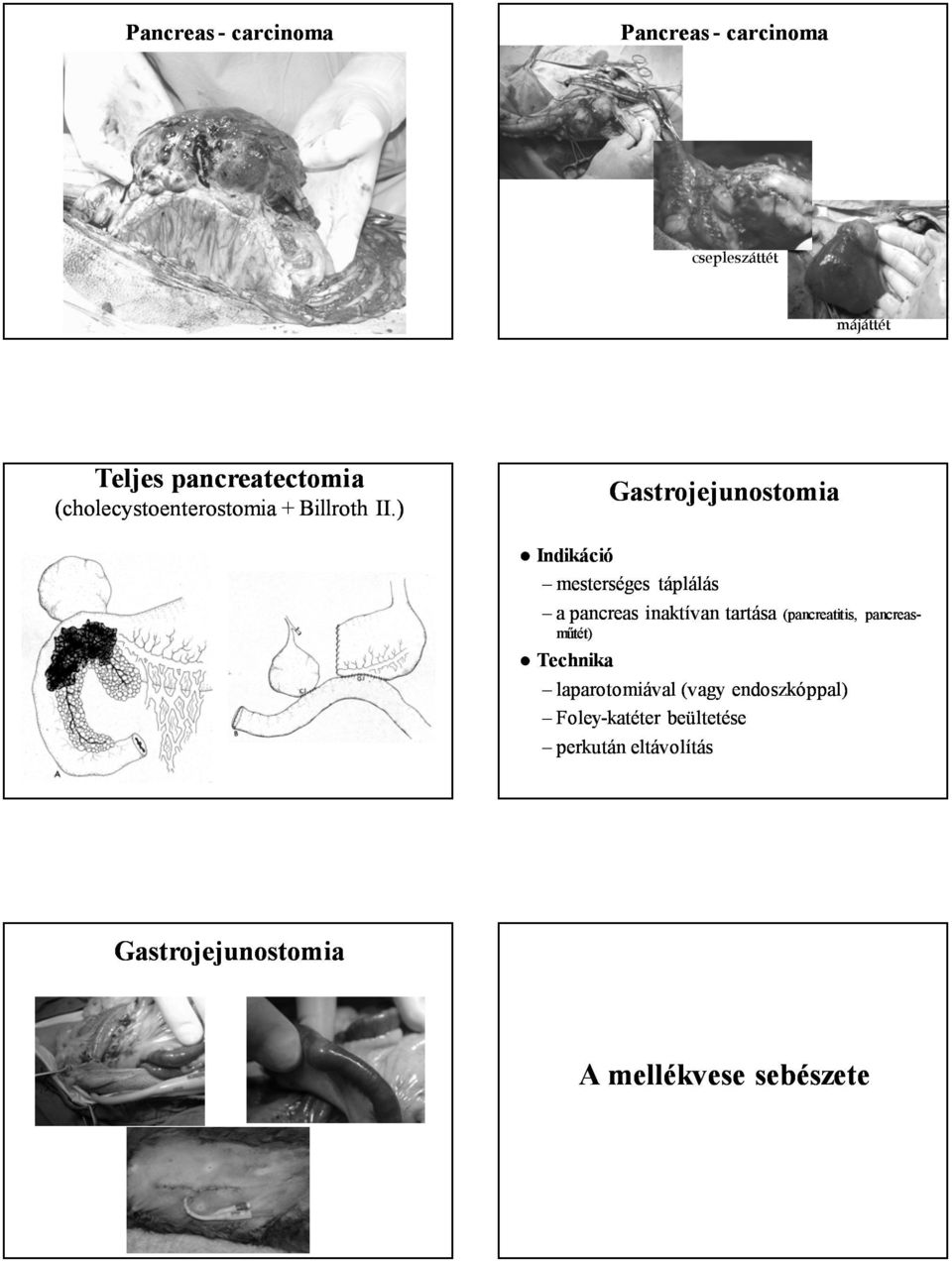 ) Gastrojejunostomia mesterséges táplálás a pancreas inaktívan tartása (pancreatitis