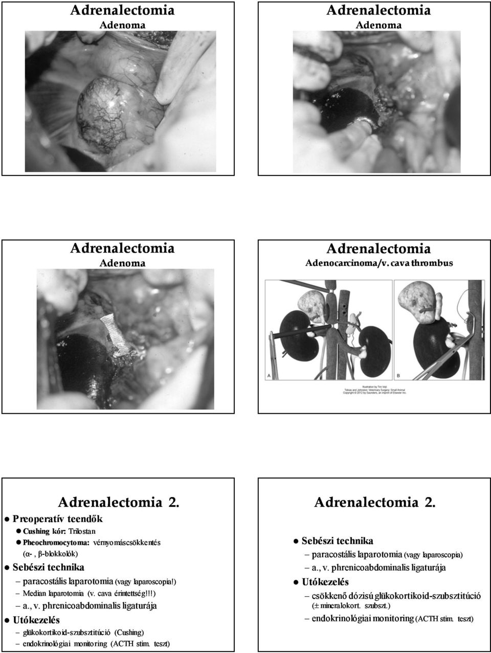 cava érintettség!!!) a., v. phrenicoabdominalis ligaturája Utókezelés glükokortikoid-szubsztitúció (Cushing) endokrinológiai monitoring (ACTH stim. teszt) Adrenalectomia 2.