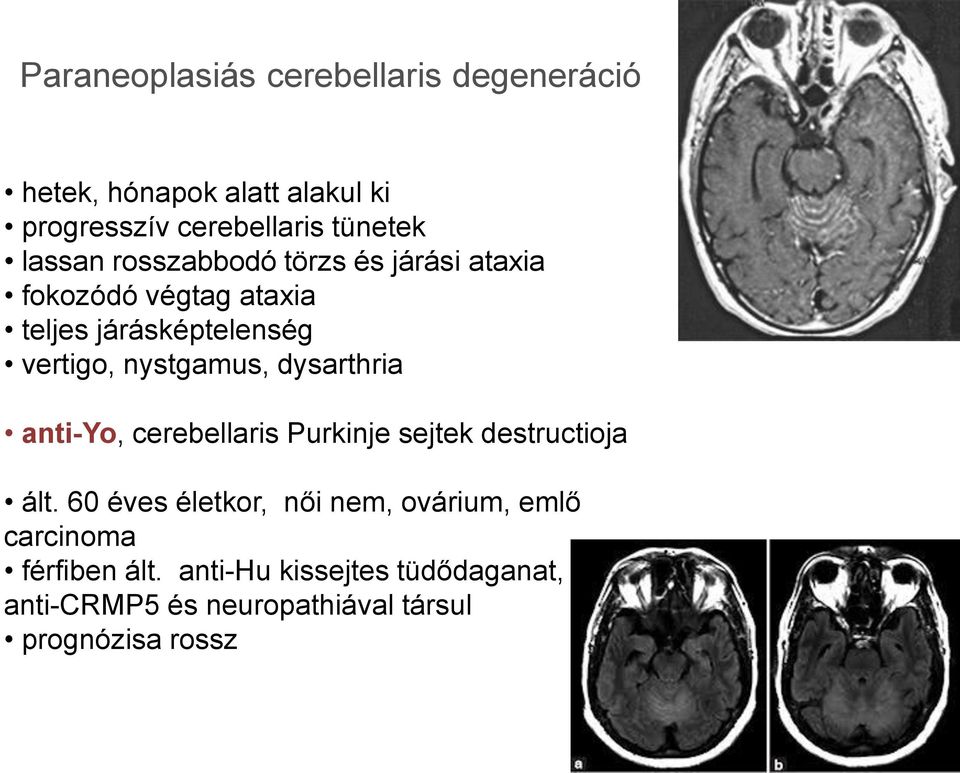 nystgamus, dysarthria anti-yo, cerebellaris Purkinje sejtek destructioja ált.