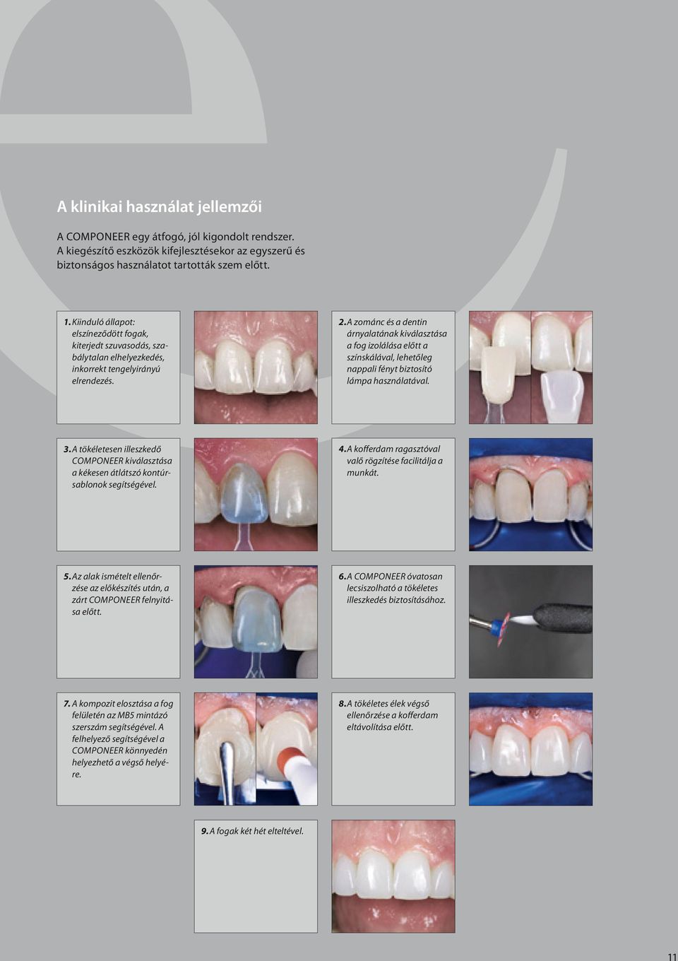 A zománc és a dentin árnyalatának kiválasztása a fog izolálása előtt a színskálával, lehetőleg nappali fényt biztosító lámpa használatával. 3.