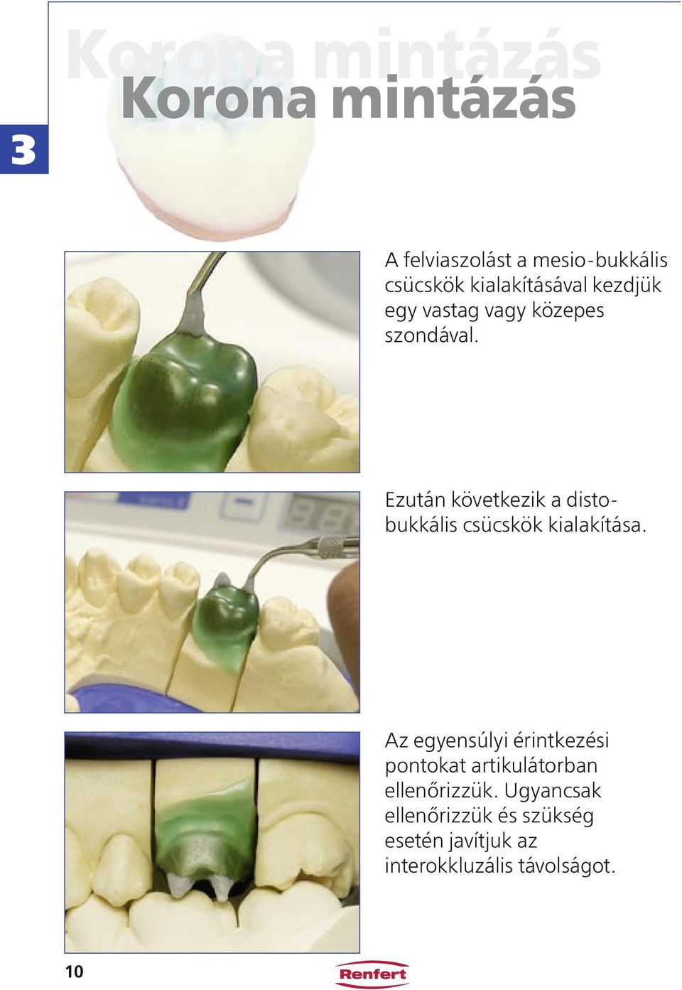 Ezután következik a distobukkális csücskök kialakítása.