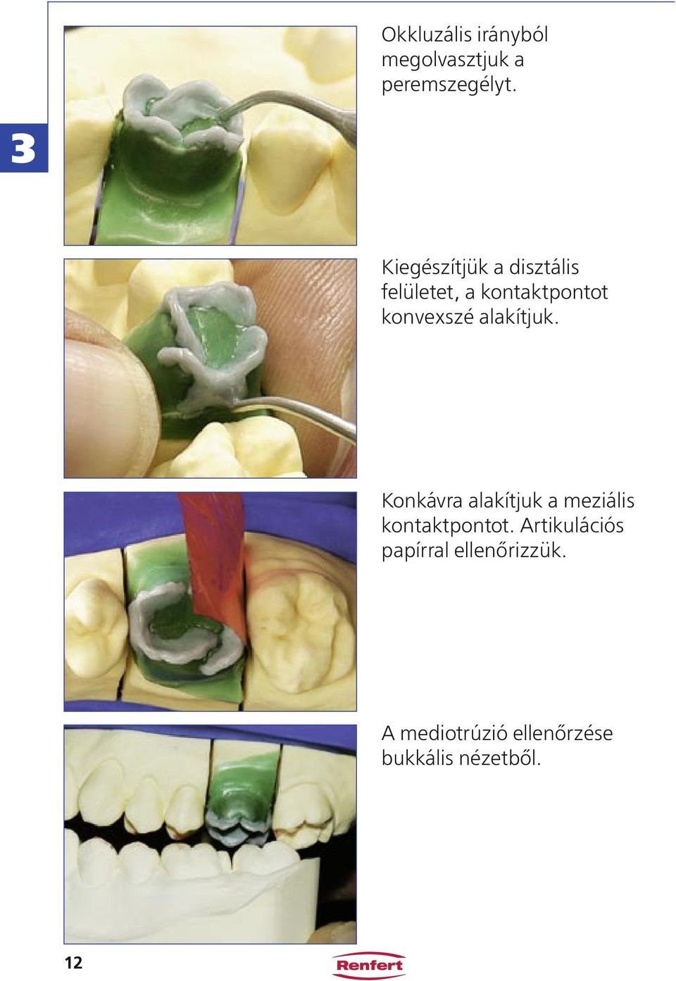 alakítjuk. Konkávra alakítjuk a meziális kontaktpontot.