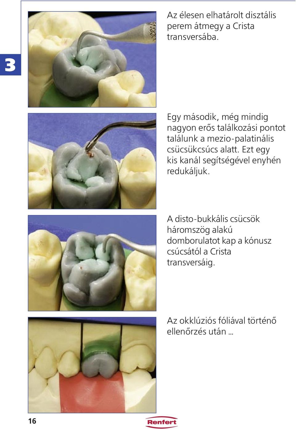 csücsükcsúcs alatt. Ezt egy kis kanál segítségével enyhén redukáljuk.