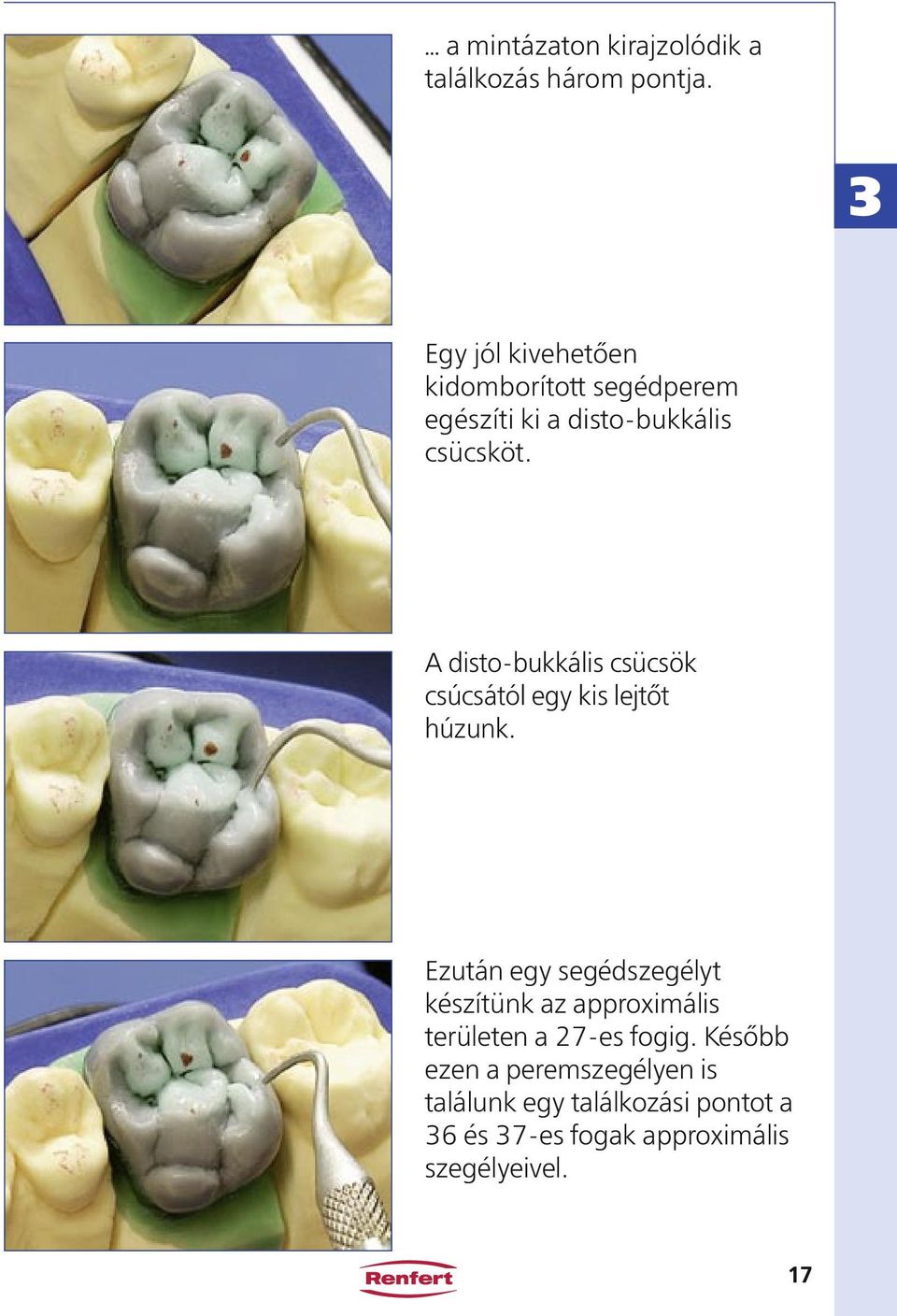 A disto-bukkális csücsök csúcsától egy kis lejtőt húzunk.