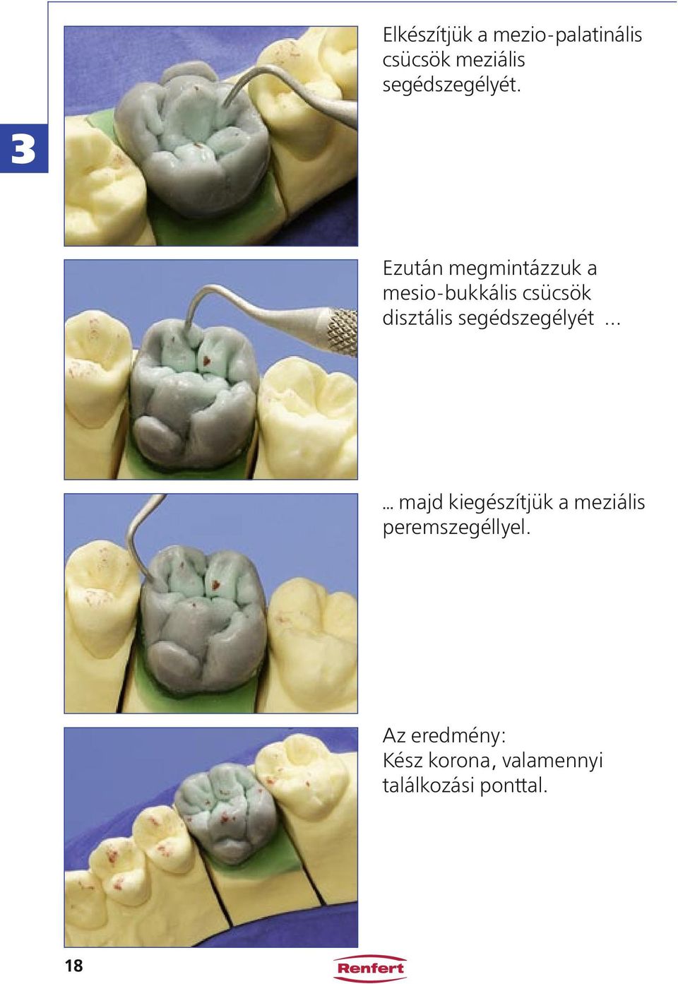 3 Ezután megmintázzuk a mesio-bukkális csücsök disztális .