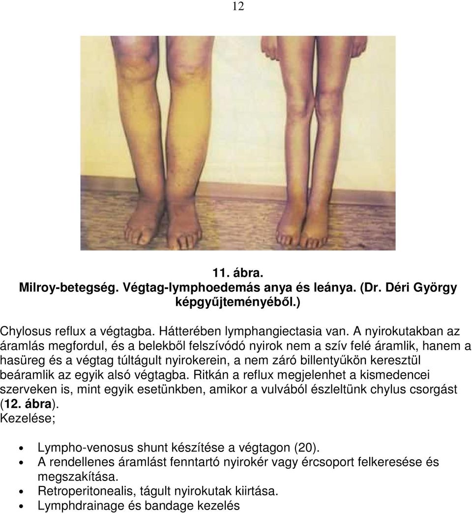 beáramlik az egyik alsó végtagba. Ritkán a reflux megjelenhet a kismedencei szerveken is, mint egyik esetünkben, amikor a vulvából észleltünk chylus csorgást (12. ábra).