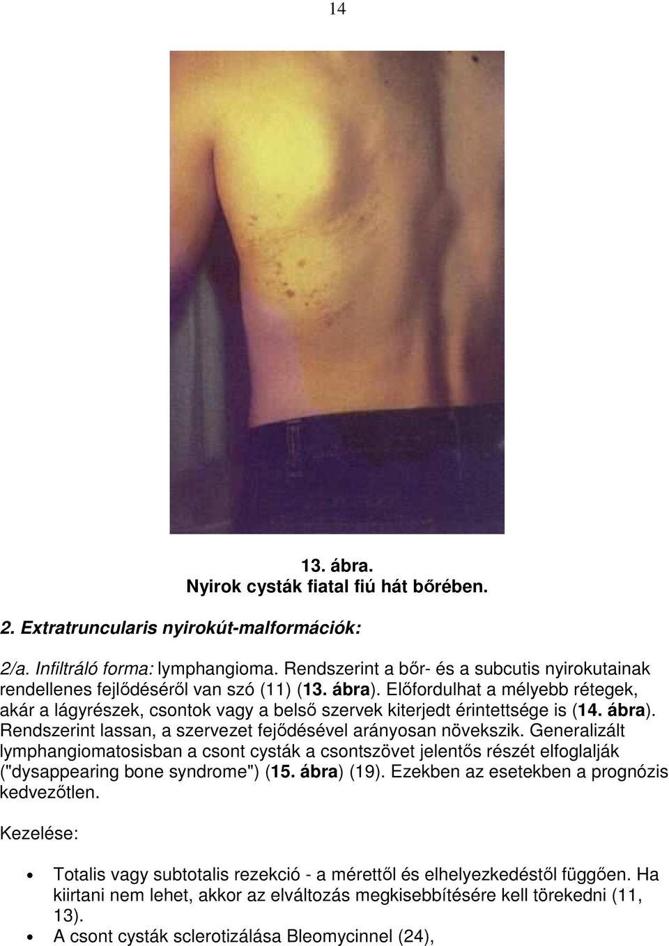 Elıfordulhat a mélyebb rétegek, akár a lágyrészek, csontok vagy a belsı szervek kiterjedt érintettsége is (14. ábra). Rendszerint lassan, a szervezet fejıdésével arányosan növekszik.