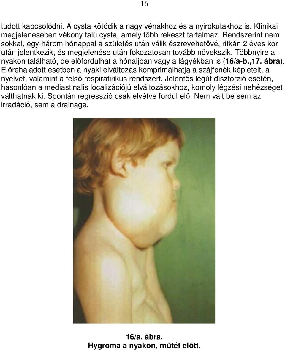 Többnyire a nyakon található, de elıfordulhat a hónaljban vagy a lágyékban is (16/a-b.,17. ábra).