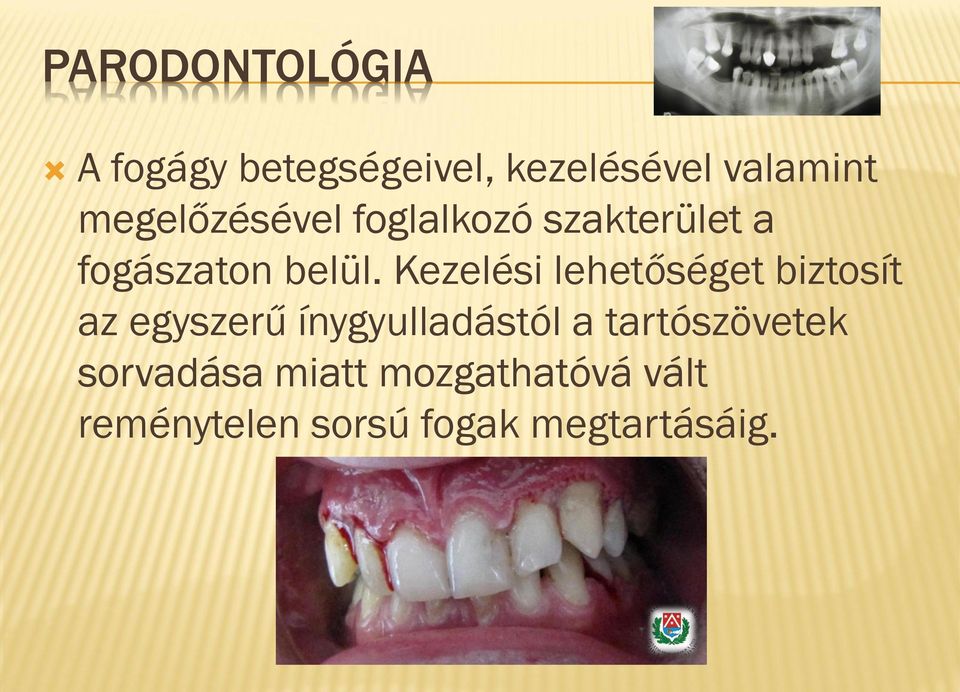 Kezelési lehetőséget biztosít az egyszerű ínygyulladástól a