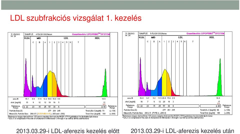 29-i LDL-aferezis kezelés