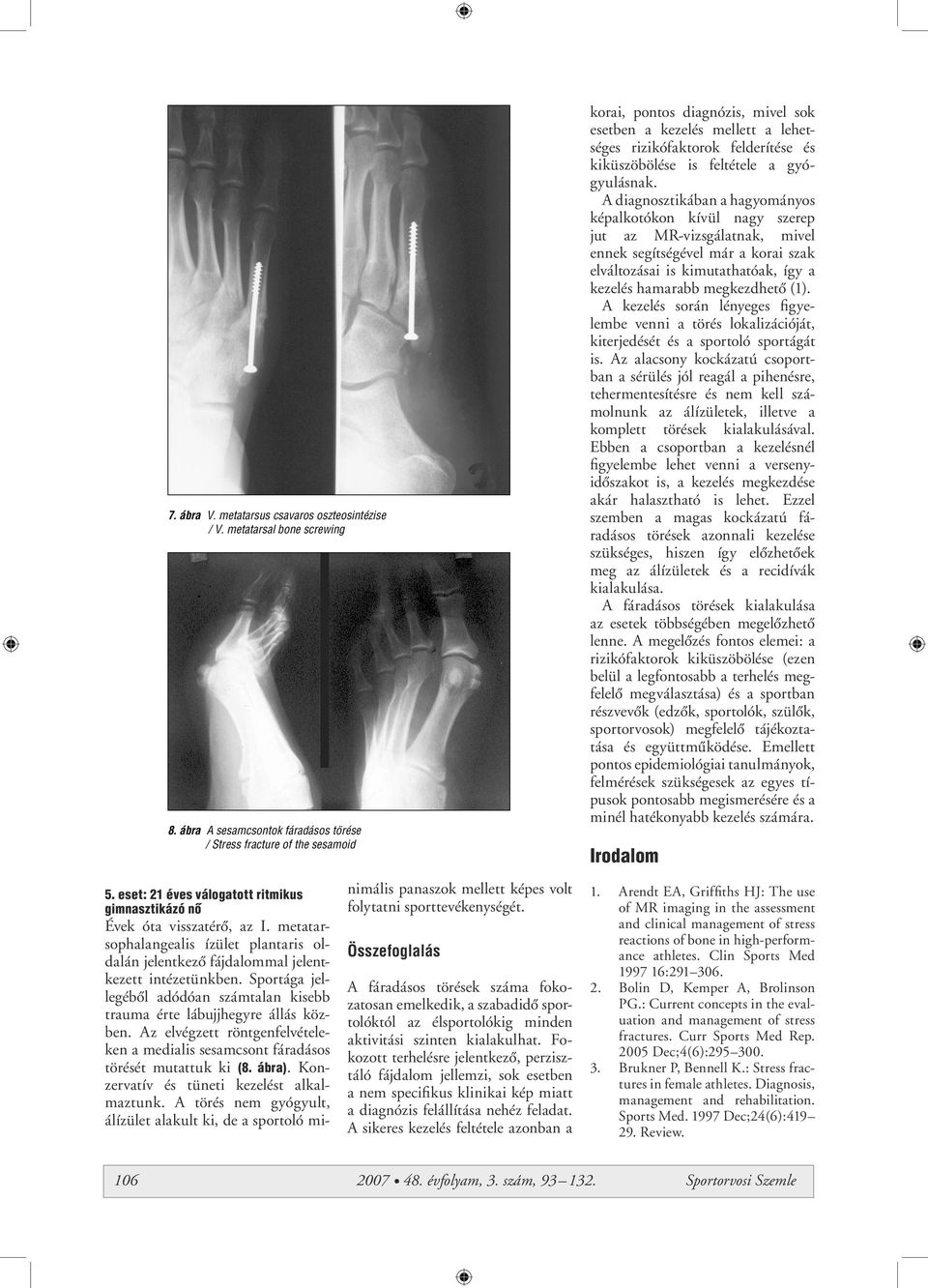 Sportága jellegébôl adódóan számtalan kisebb trauma érte lábujjhegyre állás közben. Az elvégzett röntgenfelvételeken a medialis sesamcsont fáradásos törését mutattuk ki (8. ábra).