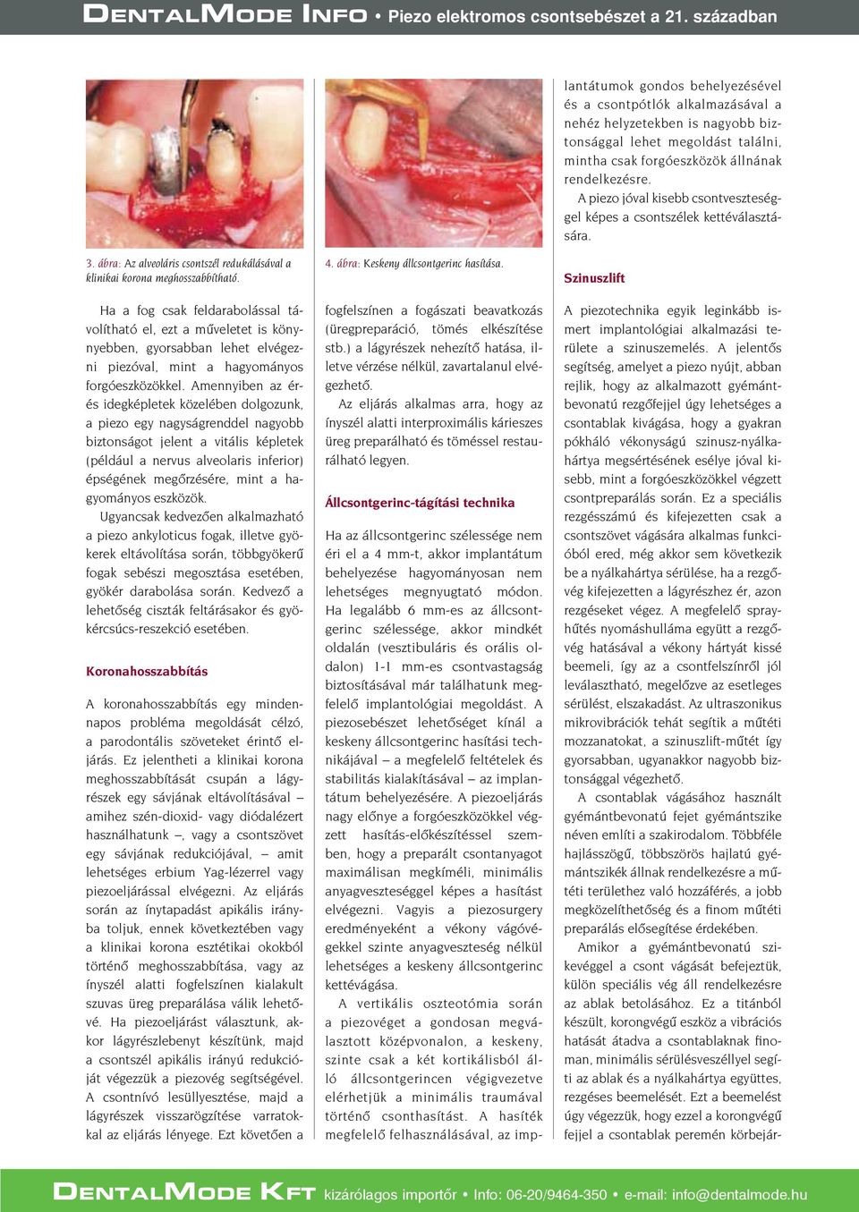 A piezosebészet lehetőséget kínál a keskeny állcsontgerinc hasítási technikájával a megfelelő feltételek és stabilitás kialakításával az implantátum behelyezésére.