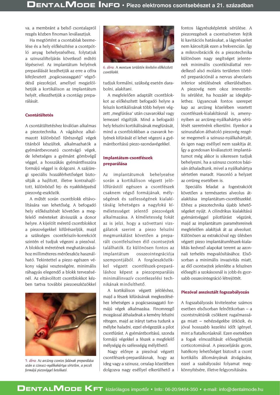 Az implantátum helyének preparálását kezdhetjük az erre a célra kifejlesztett pogácsaszaggató végződésű piezofejjel, amellyel megjelölhetjük a kortikálison az implantátum helyét, elkezdhetjük a