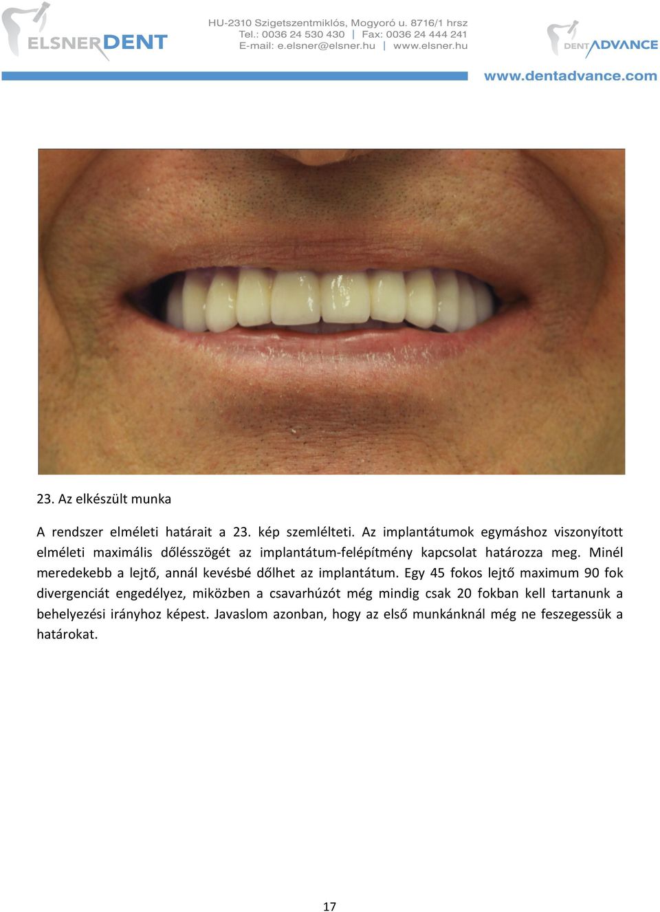 Minél meredekebb a lejtő, annál kevésbé dőlhet az implantátum.