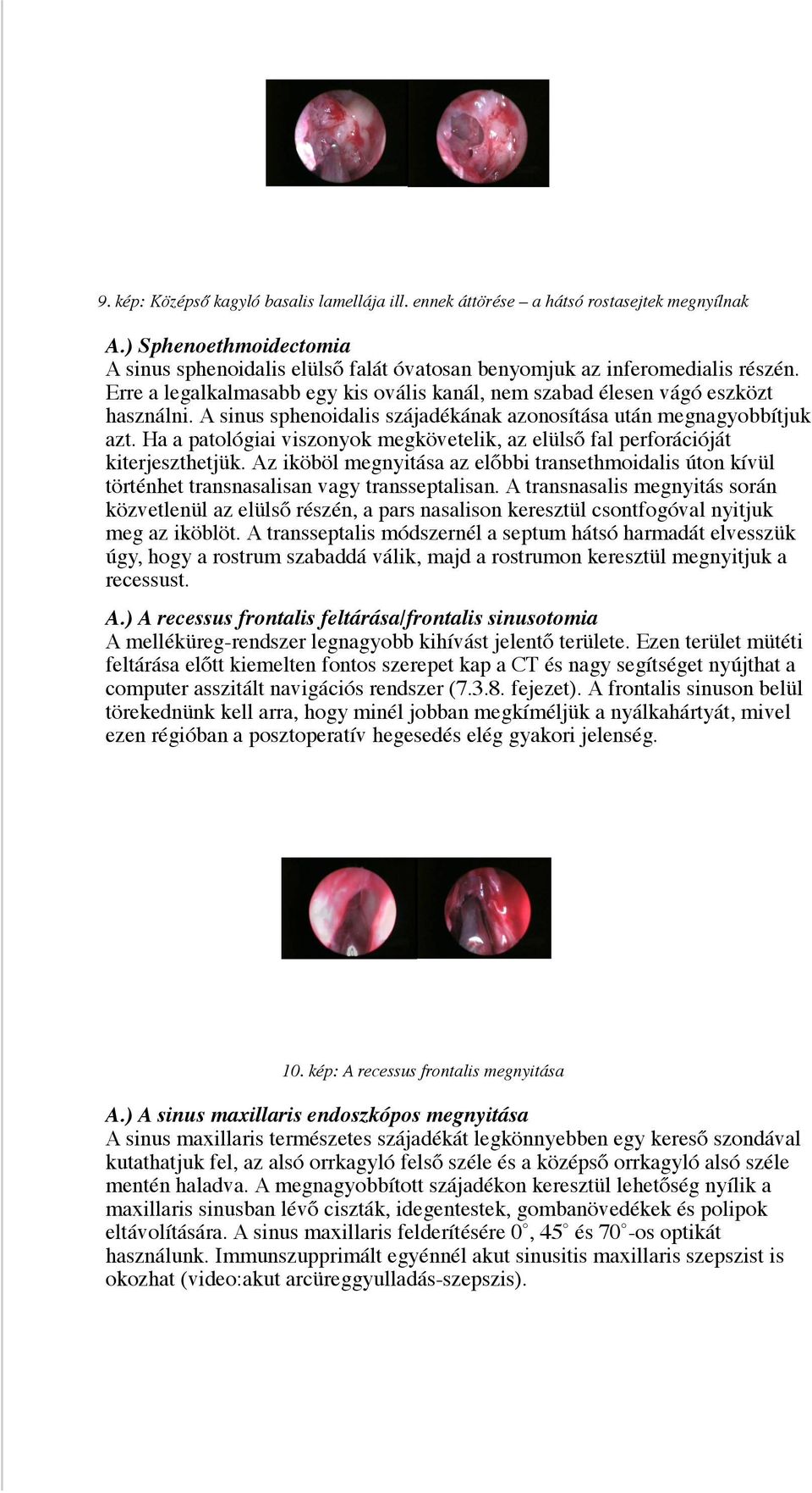 Ha a patológiai viszonyok megkövetelik, az elülső fal perforációját kiterjeszthetjük. Az iköböl megnyitása az előbbi transethmoidalis úton kívül történhet transnasalisan vagy transseptalisan.
