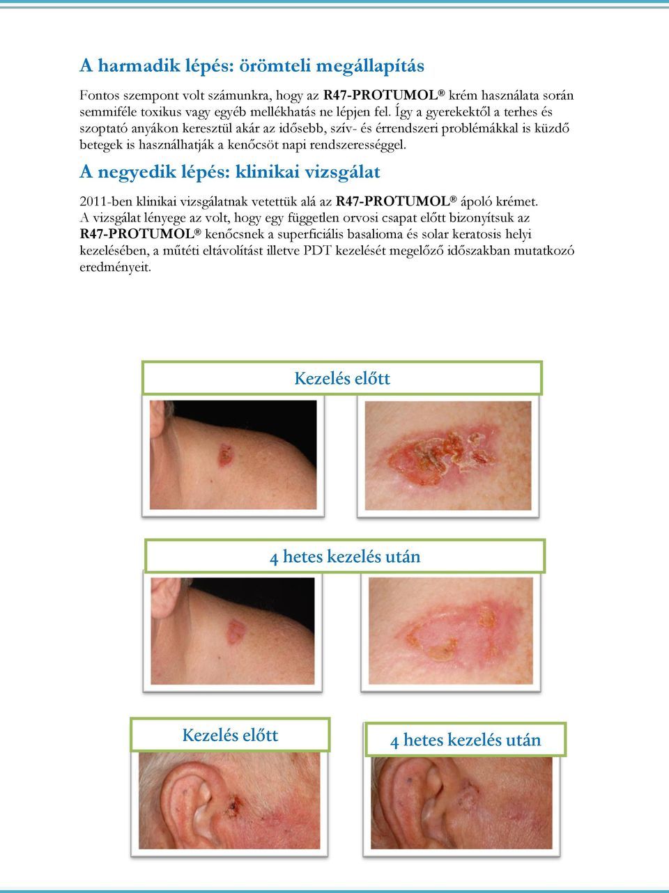 A negyedik lépés: klinikai vizsgálat 2011-ben klinikai vizsgálatnak vetettük alá az R47-PROTUMOL ápoló krémet.