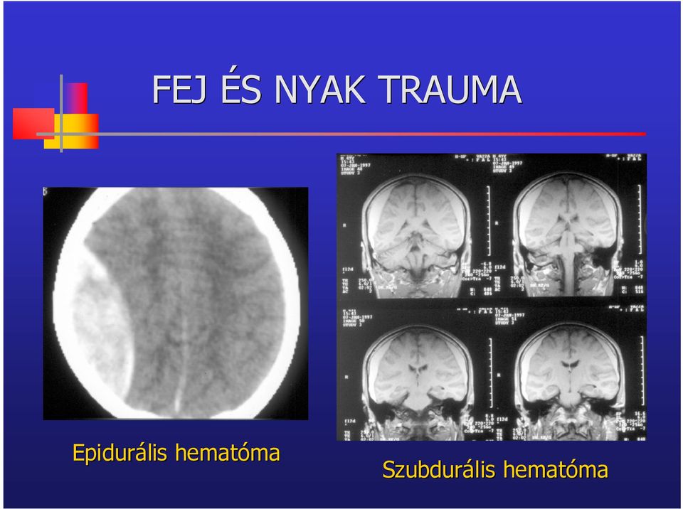 Epidurális