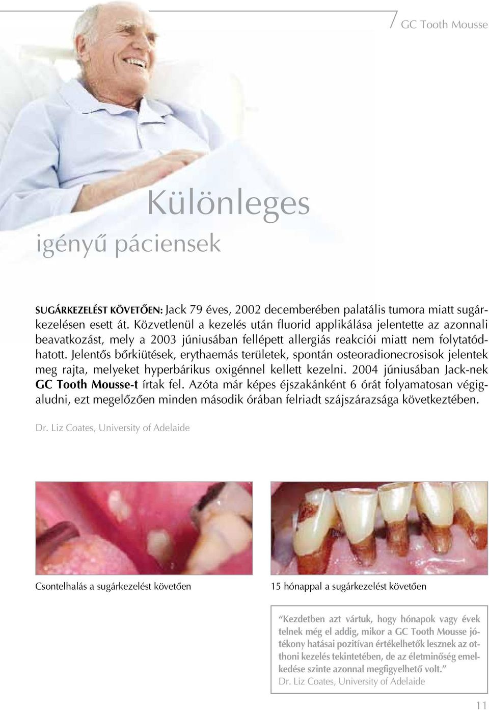 Jelentôs bôrkiütések, erythaemás területek, spontán osteoradionecrosisok jelentek meg rajta, melyeket hyperbárikus oxigénnel kellett kezelni. 2004 júniusában Jack-nek GC Tooth Mousse-t írtak fel.