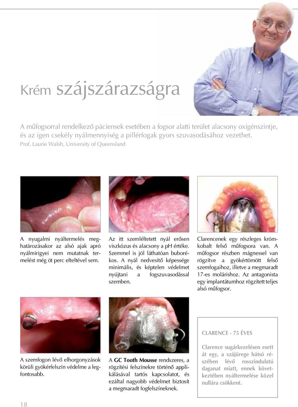 Az itt szemléltetett nyál erôsen viszkózus és alacsony a ph értéke. Szemmel is jól láthatóan buborékos. A nyál nedvesítô képessége minimális, és képtelen védelmet nyújtani a fogszuvasodással szemben.