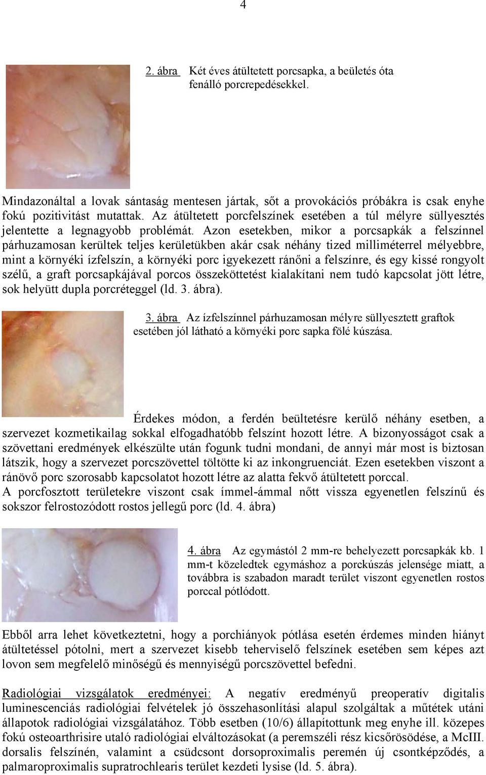 Azon esetekben, mikor a porcsapkák a felszínnel párhuzamosan kerültek teljes kerületükben akár csak néhány tized milliméterrel mélyebbre, mint a környéki ízfelszín, a környéki porc igyekezett ránőni