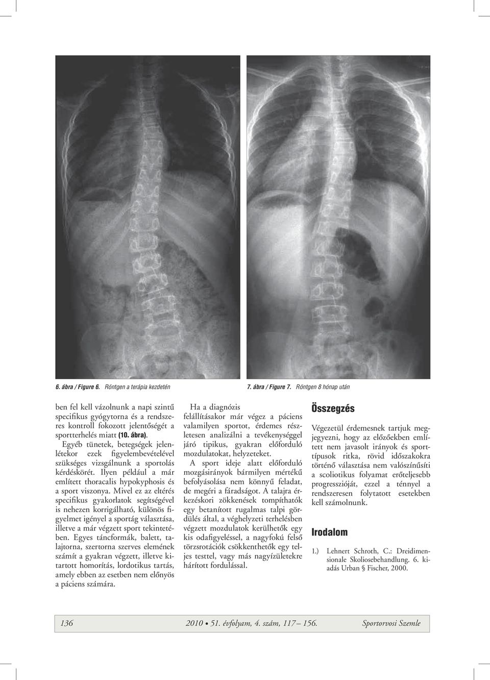 Egyéb tünetek, betegségek jelenlétekor ezek figyelembevételével szükséges vizsgálnunk a sportolás kérdéskörét. Ilyen például a már említett thoracalis hypokyphosis és a sport viszonya.