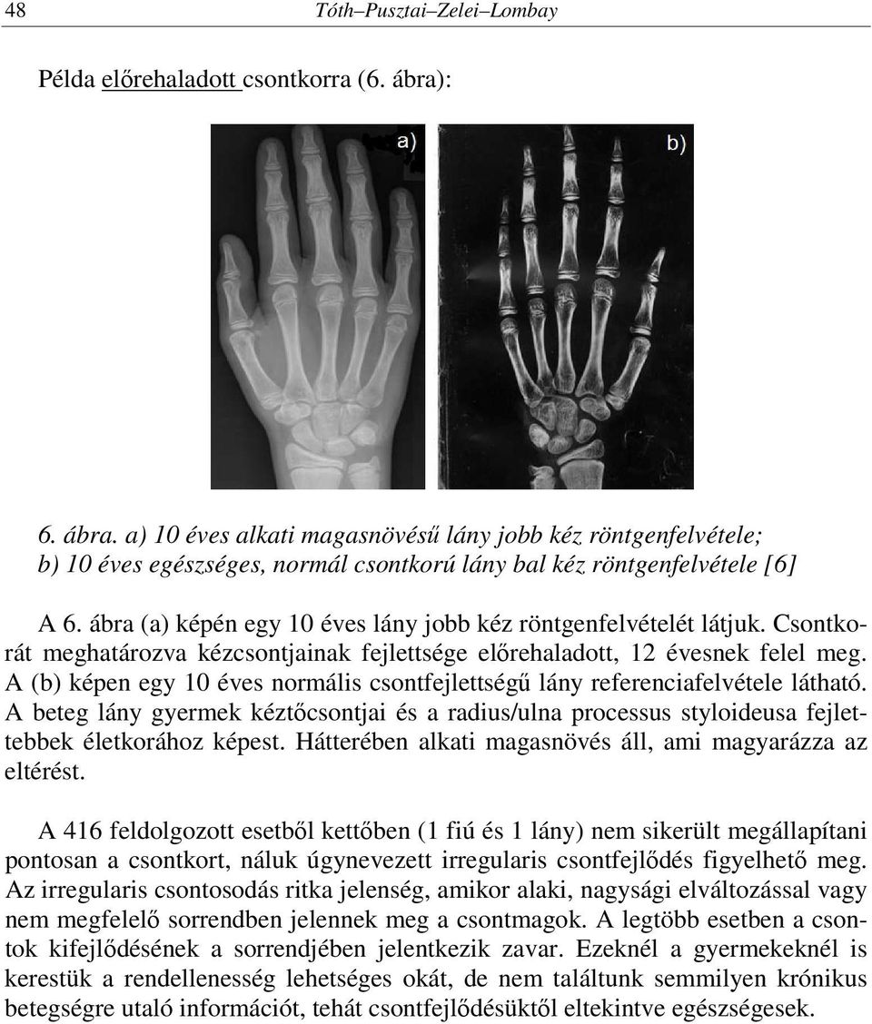 ábra (a) képén egy 10 éves lány jobb kéz röntgenfelvételét látjuk. Csontkorát meghatározva kézcsontjainak fejlettsége előrehaladott, 12 évesnek felel meg.