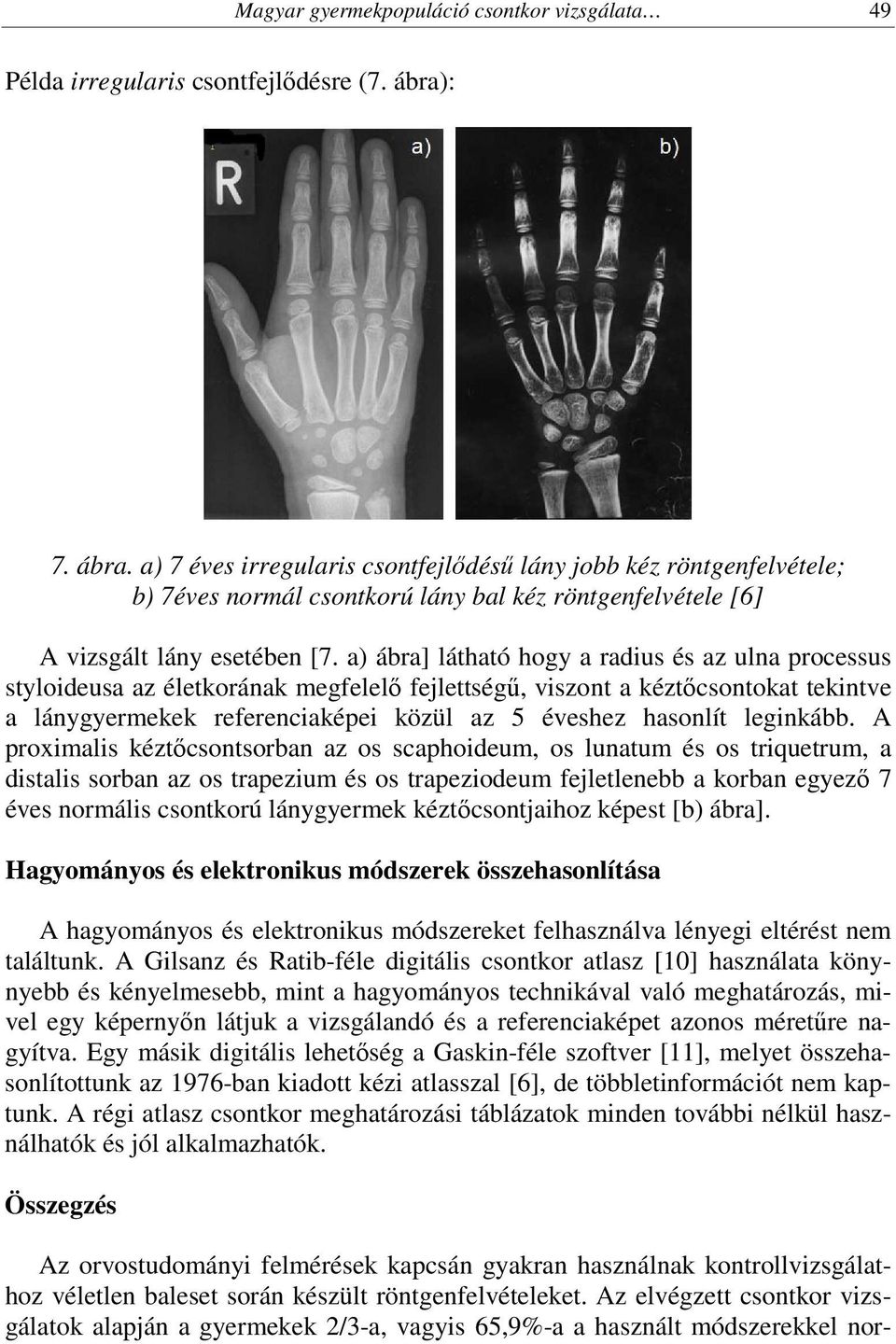 a) ábra] látható hogy a radius és az ulna processus styloideusa az életkorának megfelelő fejlettségű, viszont a kéztőcsontokat tekintve a lánygyermekek referenciaképei közül az 5 éveshez hasonlít