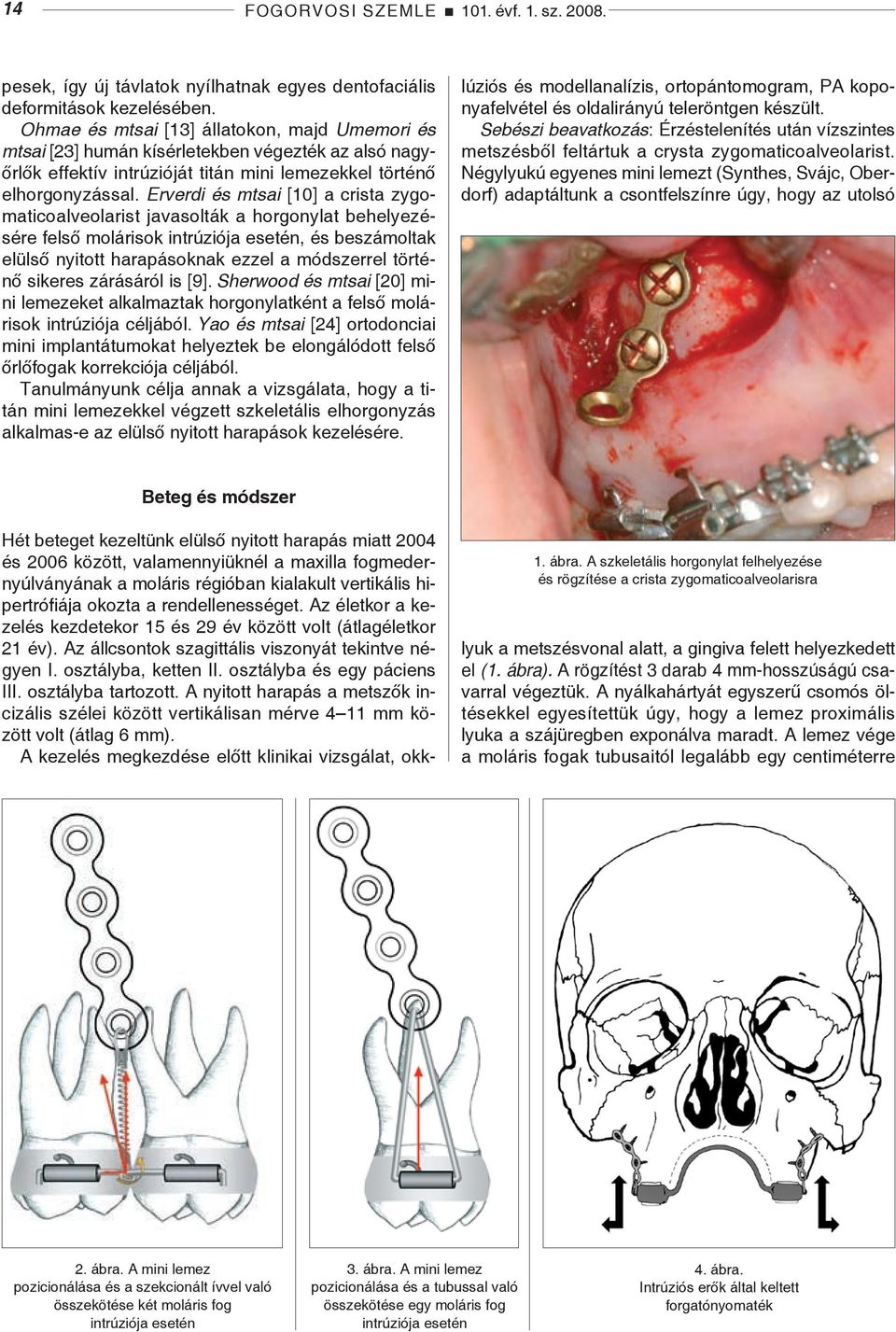 Erverdi és mtsai [10] a crista zygomaticoalveolarist javasolták a horgonylat behelyezésére felső molárisok intrúziója esetén, és beszámoltak elülső nyitott harapásoknak ezzel a módszerrel történő