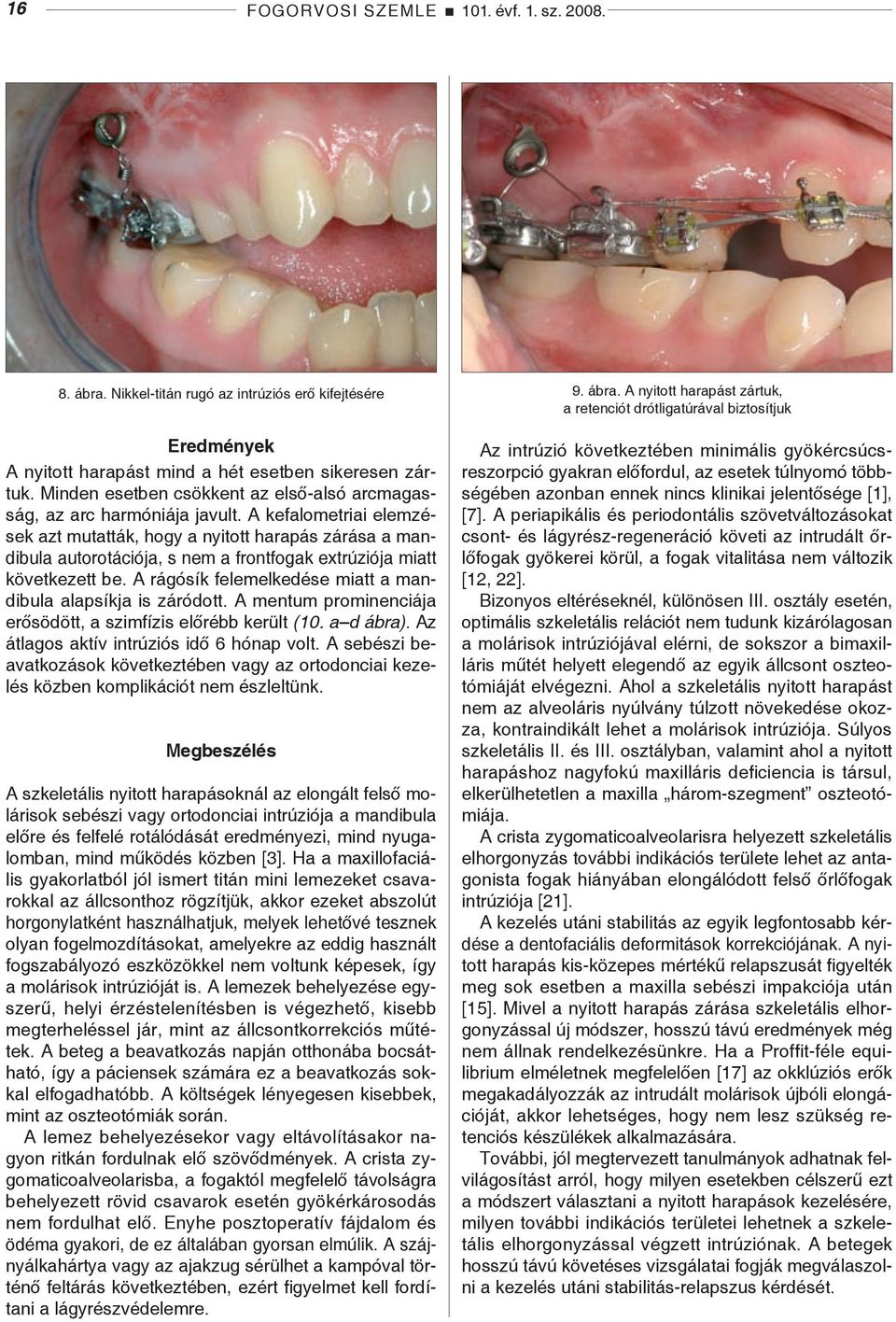 A kefalometriai elemzések azt mutatták, hogy a nyitott harapás zárása a mandibula autorotációja, s nem a frontfogak extrúziója miatt következett be.