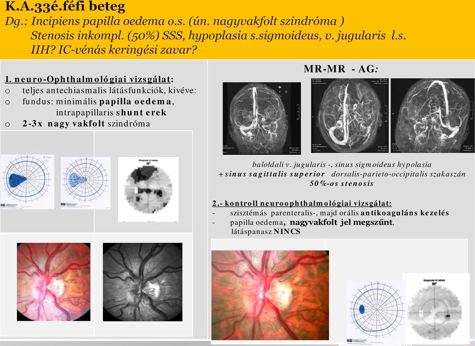 jugularis -, sinus sigmideus hyplasia + sinus sagittalis superir drsalis-pariet-ccipitalis szakaszán 50%-s stensis 2.