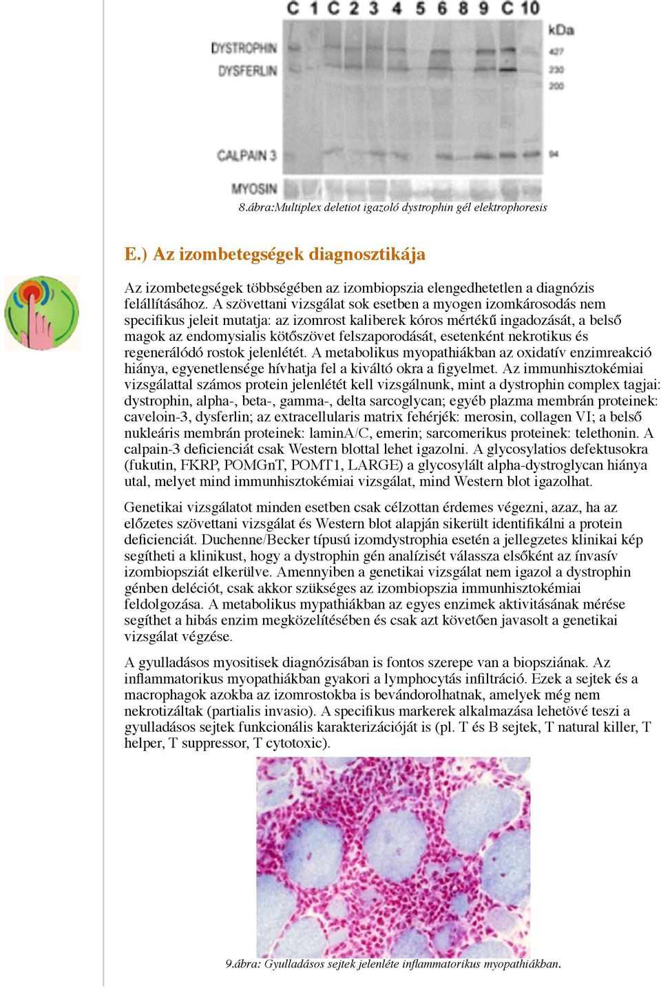 esetenként nekrotikus és regenerálódó rostok jelenlétét. A metabolikus myopathiákban az oxidatív enzimreakció hiánya, egyenetlensége hívhatja fel a kiváltó okra a figyelmet.