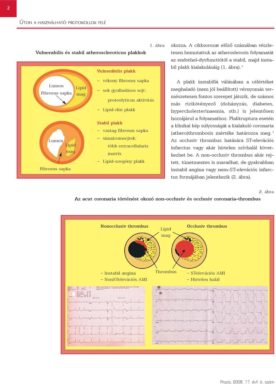 2 Lumen Fibrosus sapka Lumen Lipid mag Fibrosus sapka Lipid mag vékony fibrosus sapka sok gyulladásos sejt: proteolyticus aktivitás Lipid-dús plakk Stabil plakk vastag fibrosus sapka simaizomsejtek: