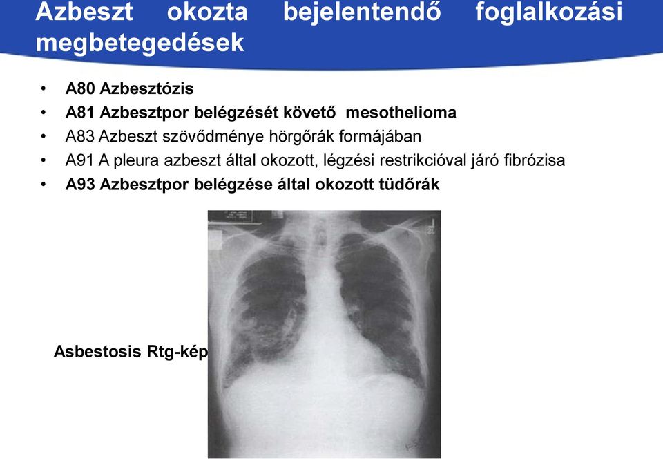 hörgőrák formájában A91 A pleura azbeszt által okozott, légzési