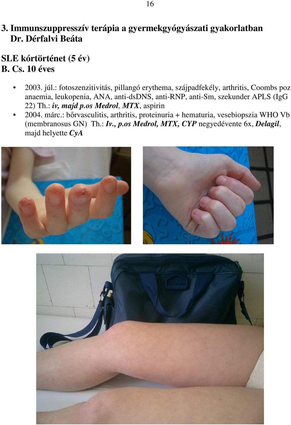 : fotoszenzitivitás, pillangó erythema, szájpadfekély, arthritis, Coombs poz anaemia, leukopenia, ANA, anti-dsdns, anti-rnp,
