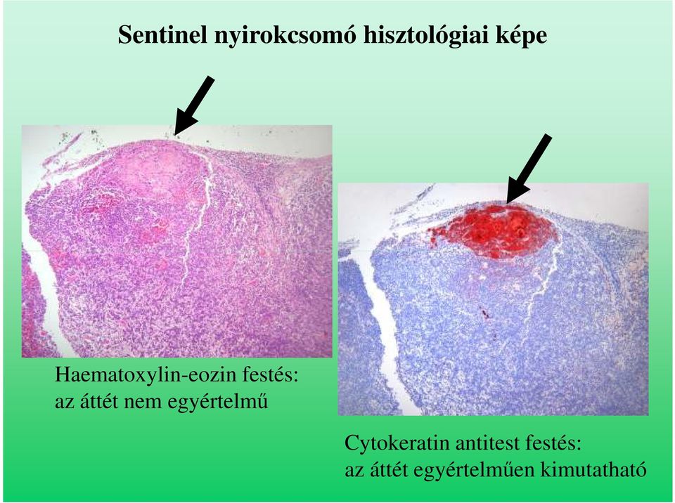 áttét nem egyértelmű Cytokeratin