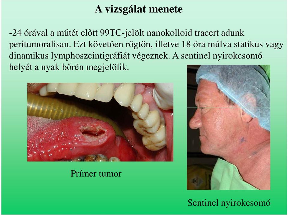 Ezt követően rögtön, illetve 18 óra múlva statikus vagy dinamikus