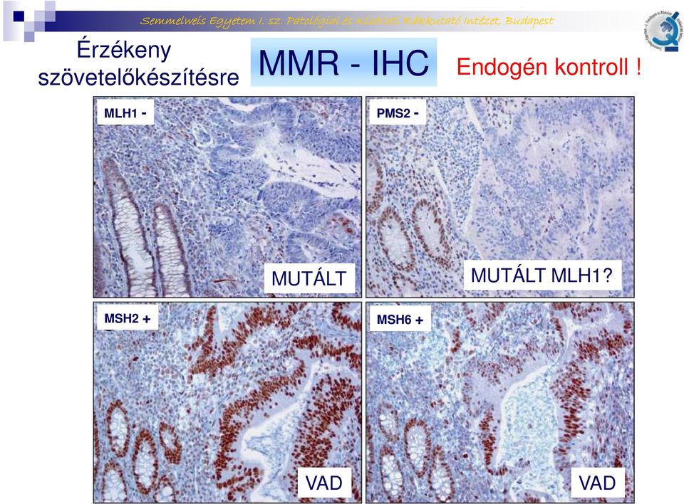 IHC MLH1 - PMS2 - Endogén
