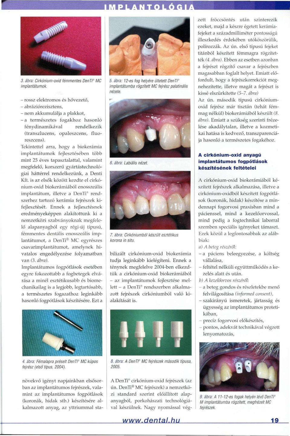 rendelkezik Tekintettel arra, hogy a biokerámia implantátumok fejlesztésében több mint 25 éves tapasztalattal, valamint megfelelő, korszerű gyártástechnológiai háttérrel rendelkezünk, a Denti Kft.