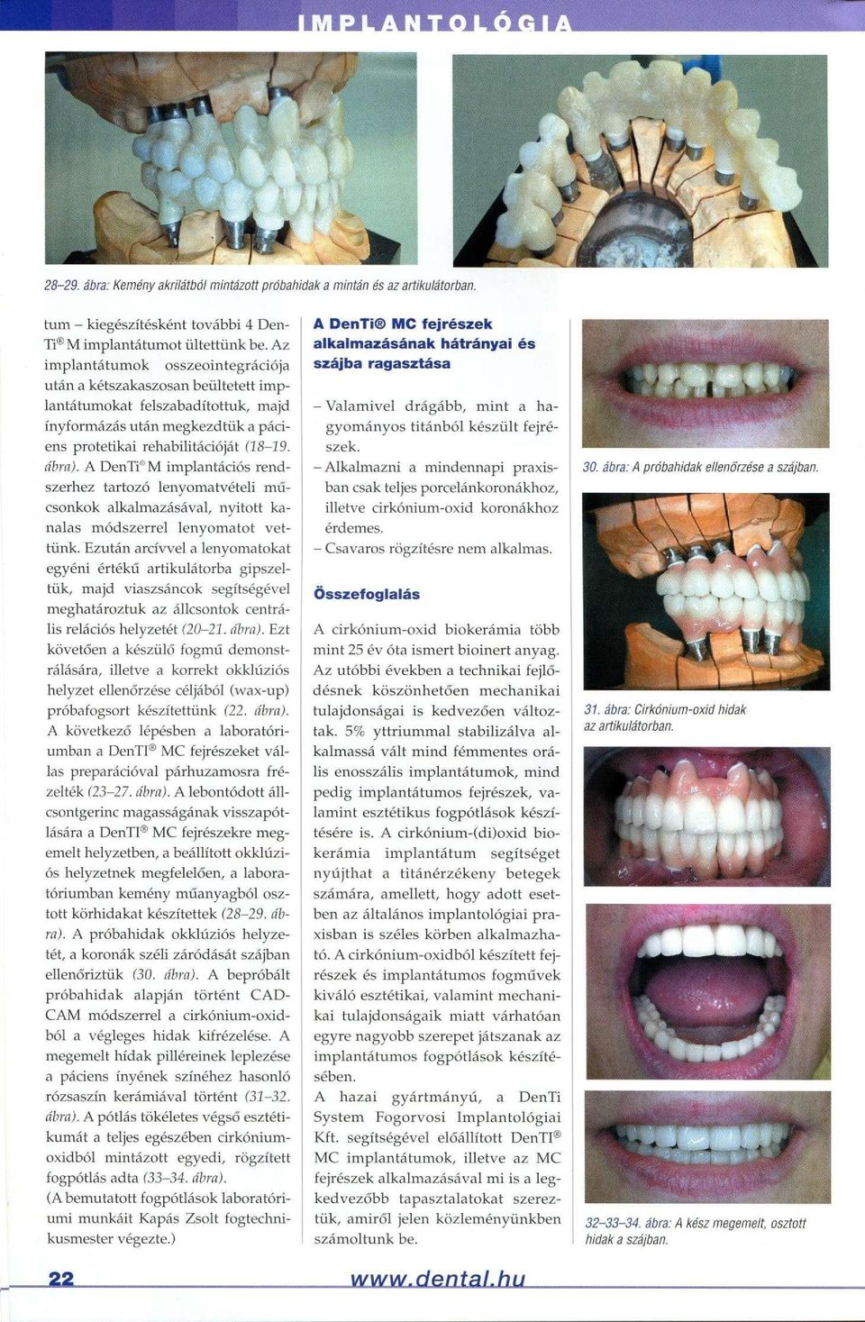 A DenTi 8 M implantációs rendszerhez tartozó lenyomatvételi műcsonkok alkalmazásával, nyitott kanalas módszerrel lenyomatot vettünk.