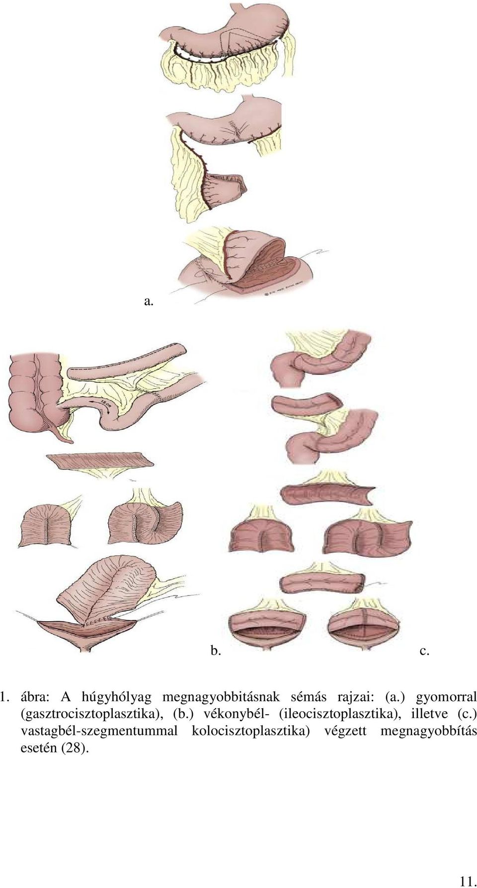 ) gyomorral (gasztrocisztoplasztika), (b.