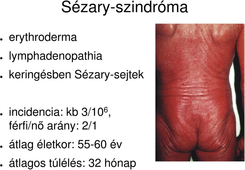 Sézary-sejtek incidencia: kb 3/10 6,
